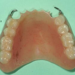 Partial dentures for upper back teeth