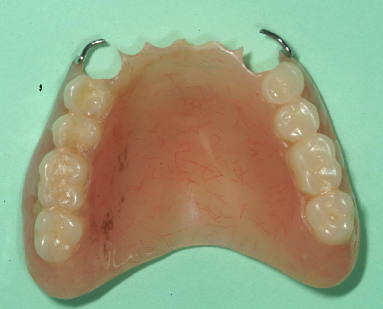 Partial dentures for upper back teeth