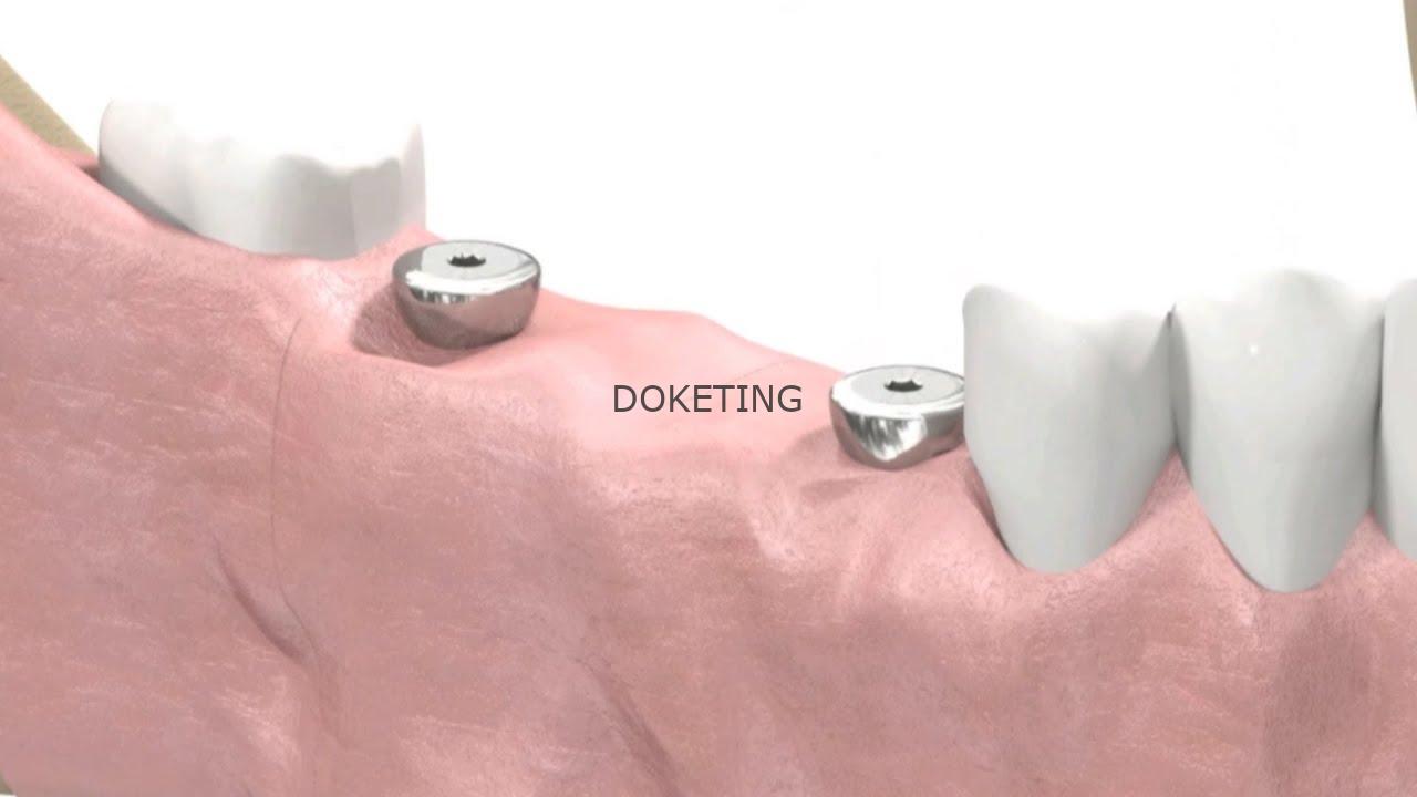 A healing collar is used in which implant procedure